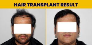 When Should You Go For A Hair Restoration Procedure?