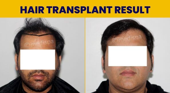 When Should You Go For A Hair Restoration Procedure?