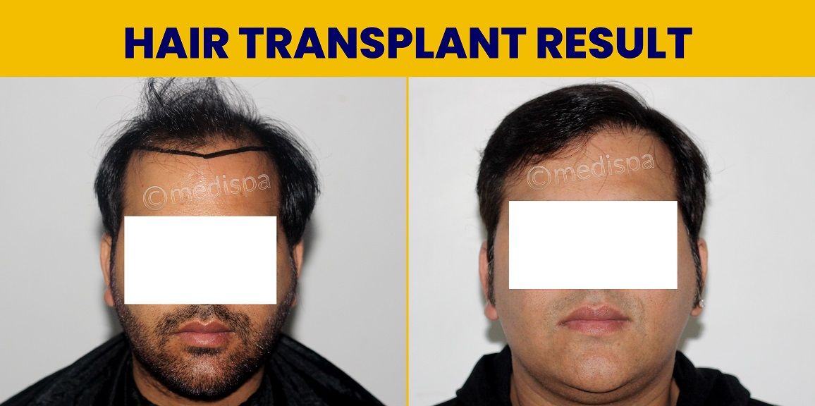 When Should You Go For A Hair Restoration Procedure?