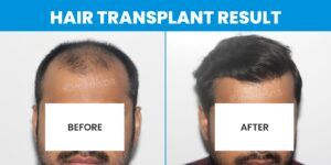Which Hair Transplant Method Is Preferable For Grade 7 Baldness?