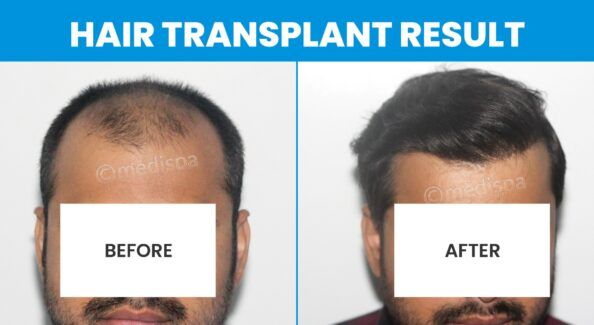 Which Hair Transplant Method Is Preferable For Grade 7 Baldness?