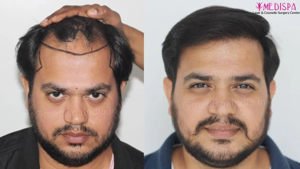 hair transplant cost in india