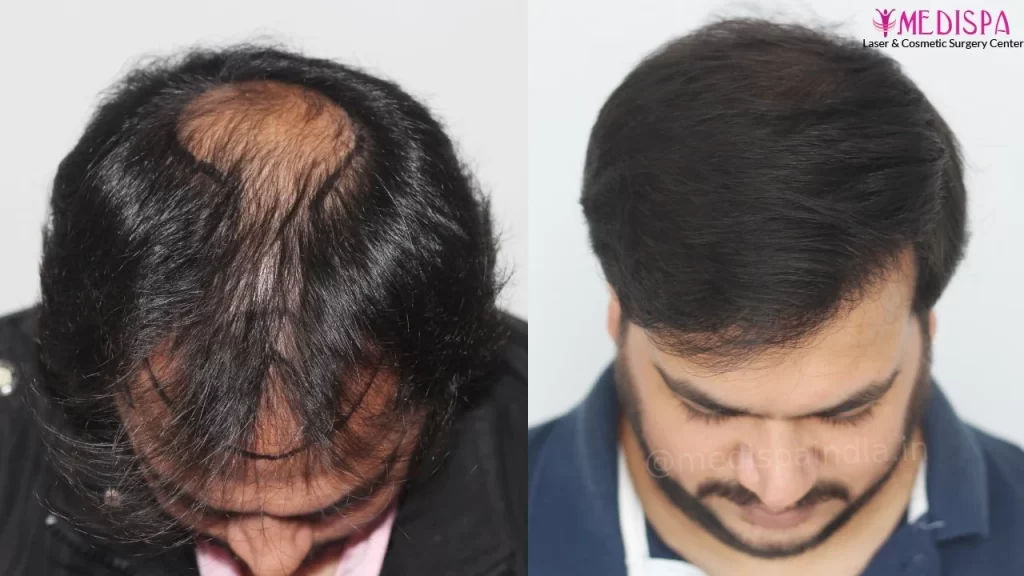 hair transplant cost