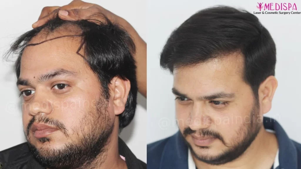 hair transplant cost