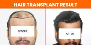 When Do The Hairs Grow Back After A Hair Transplant?
