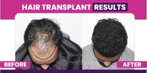 How Many Grafts Are Required For Hair Transplantation?