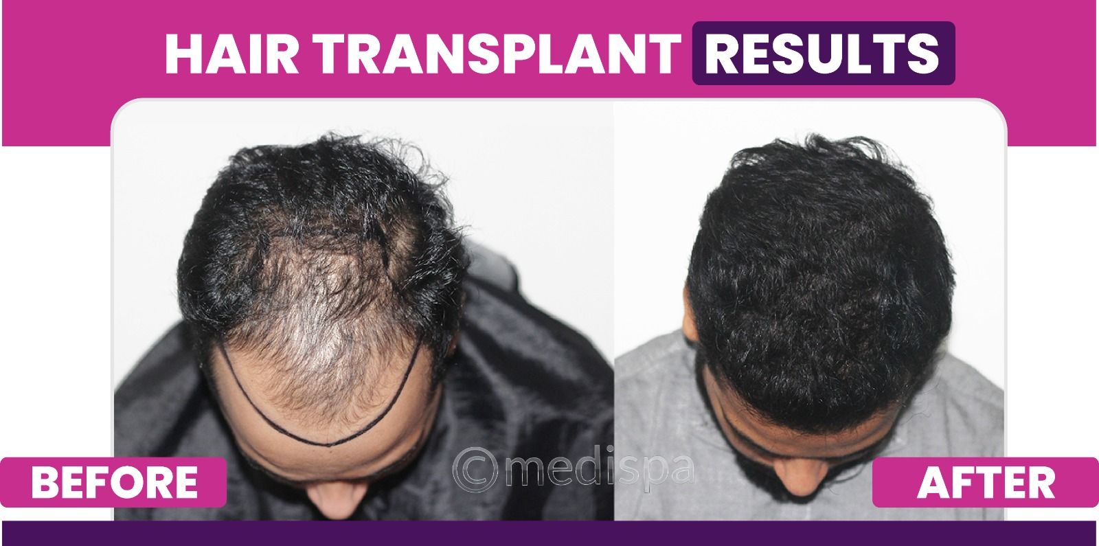 How Many Grafts Are Required For Hair Transplantation?