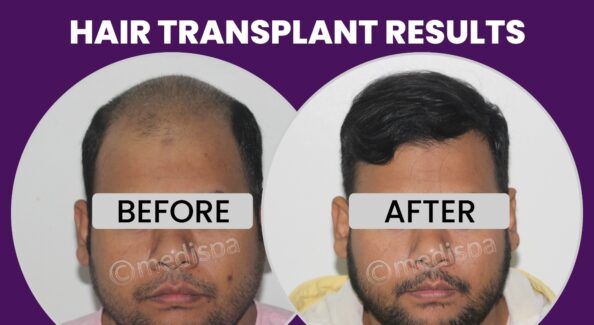 Is Hair Transplant A Viable Cure For Baldness Issue?