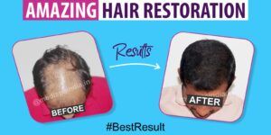 How To Achieve Thick Hair With Natural Hairline By Hair Restoration?