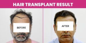 Which Is The Best Technique For Grade 6 Baldness?