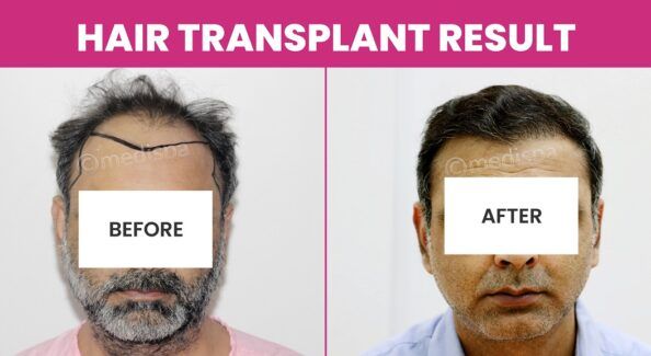 Which Is The Best Technique For Grade 6 Baldness?