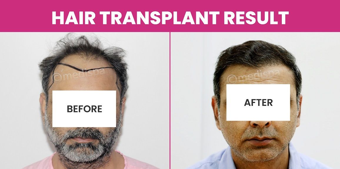 Which Is The Best Technique For Grade 6 Baldness?