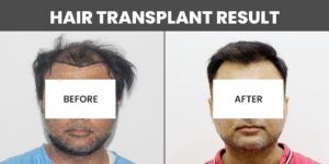 How To Get The Ideal Results After Hair Restoration?