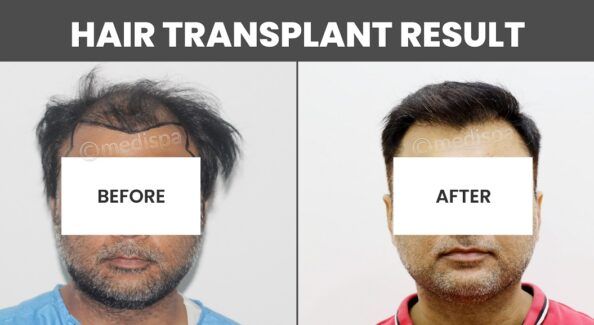 How To Get The Ideal Results After Hair Restoration?