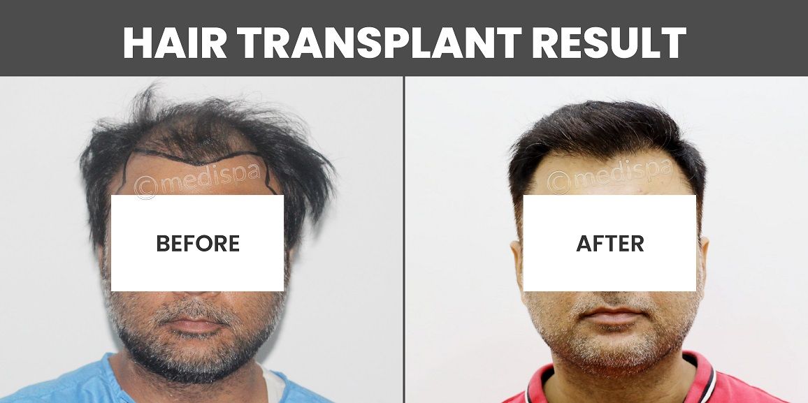 How To Get The Ideal Results After Hair Restoration?