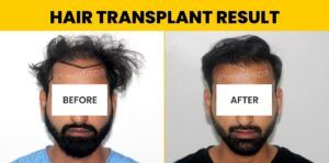 Is Hair Transplant Repair Possible With A Successful Result?