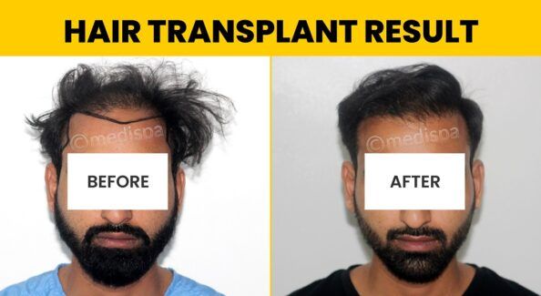 Is Hair Transplant Repair Possible With A Successful Result?