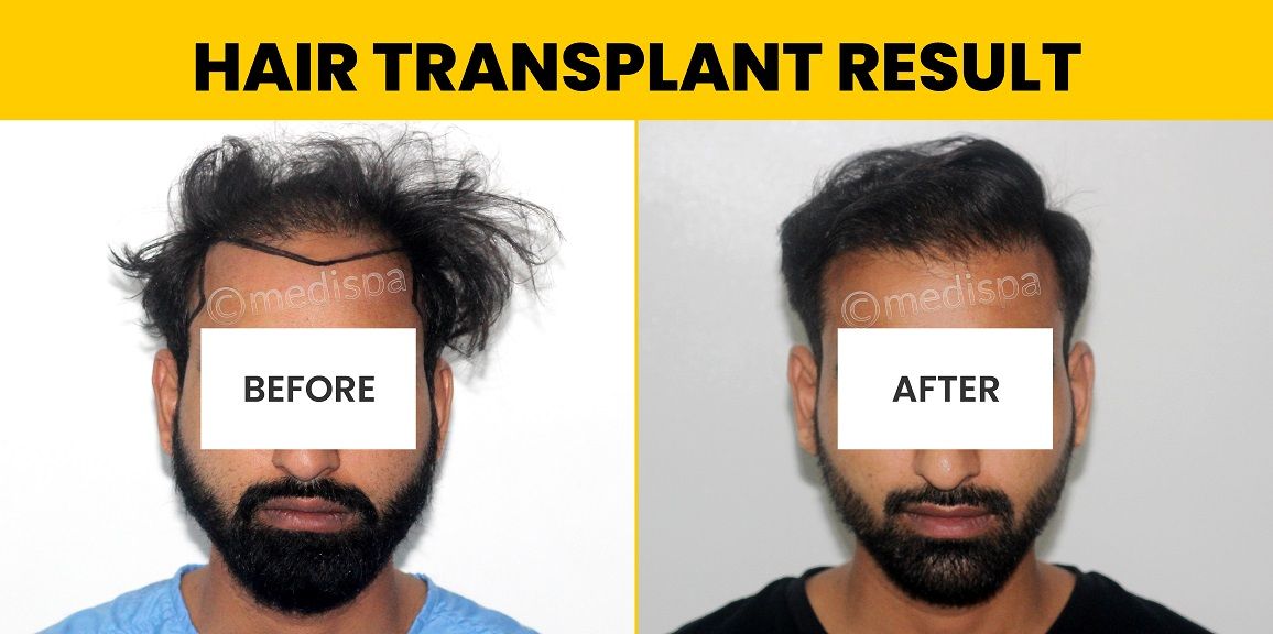 Is Hair Transplant Repair Possible With A Successful Result?