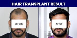 How To Select The Best Hair Transplant Clinic For High-Quality Treatment?