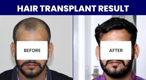 How To Select The Best Hair Transplant Clinic For High-Quality Treatment?