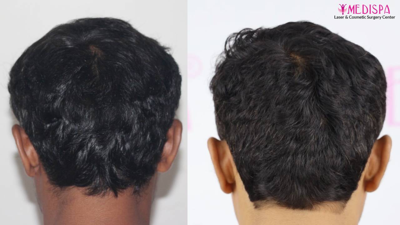 12 month hair transplant result indore