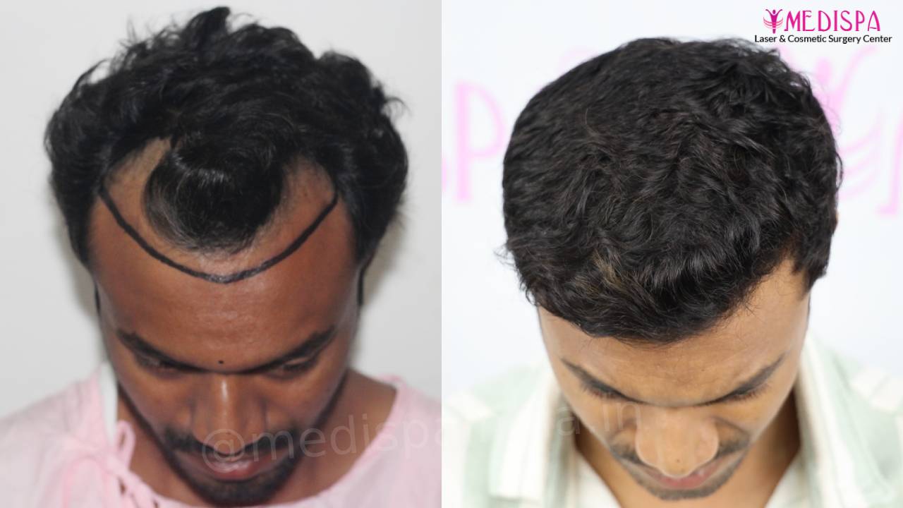 hair transplant result indore