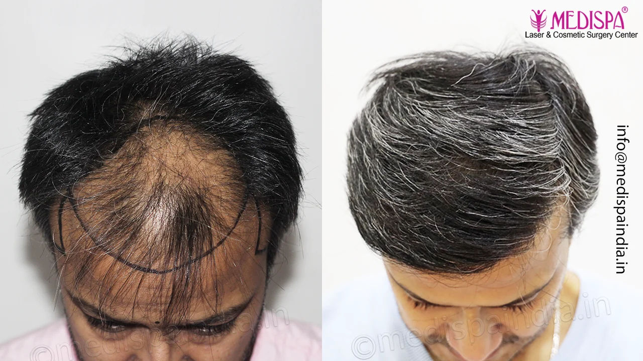 best hair transplant result india