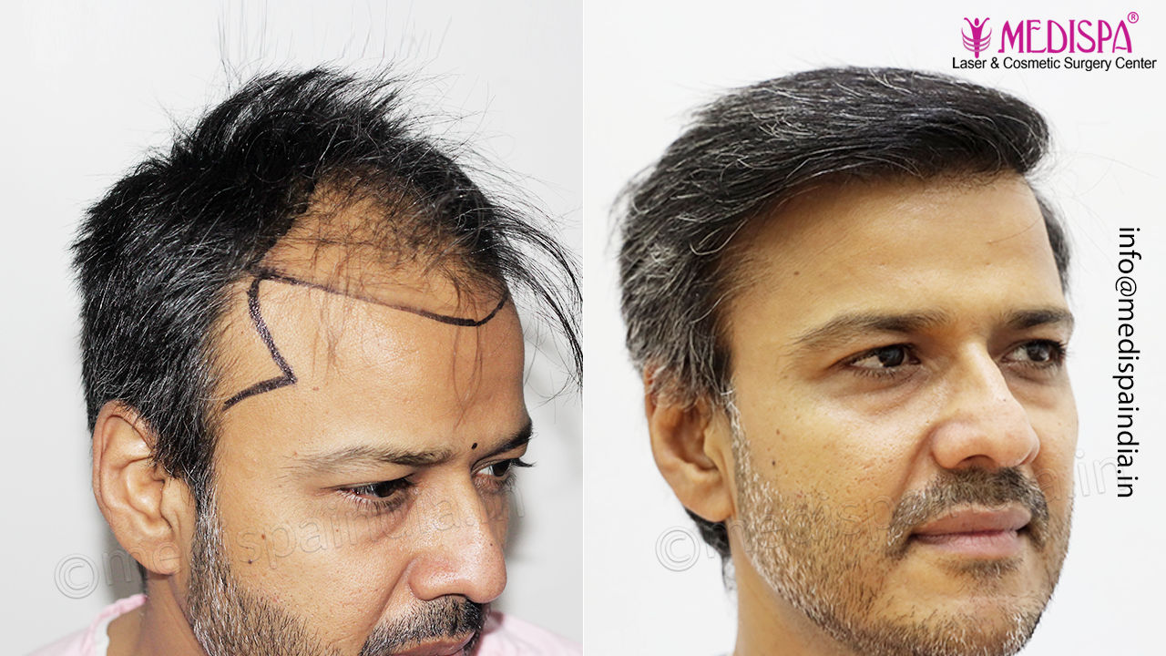 hair transplant doctor result india