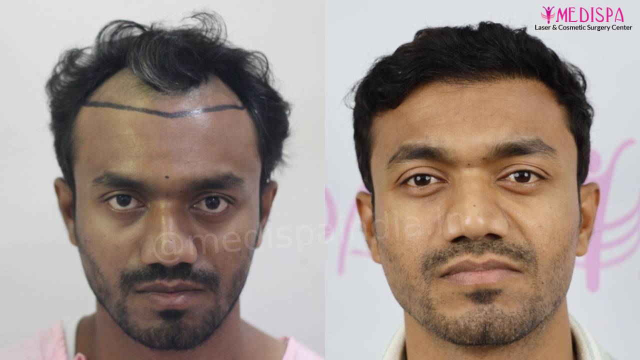hair transplant indore