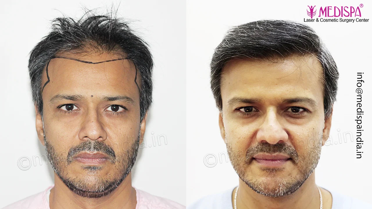 hair transplant result india