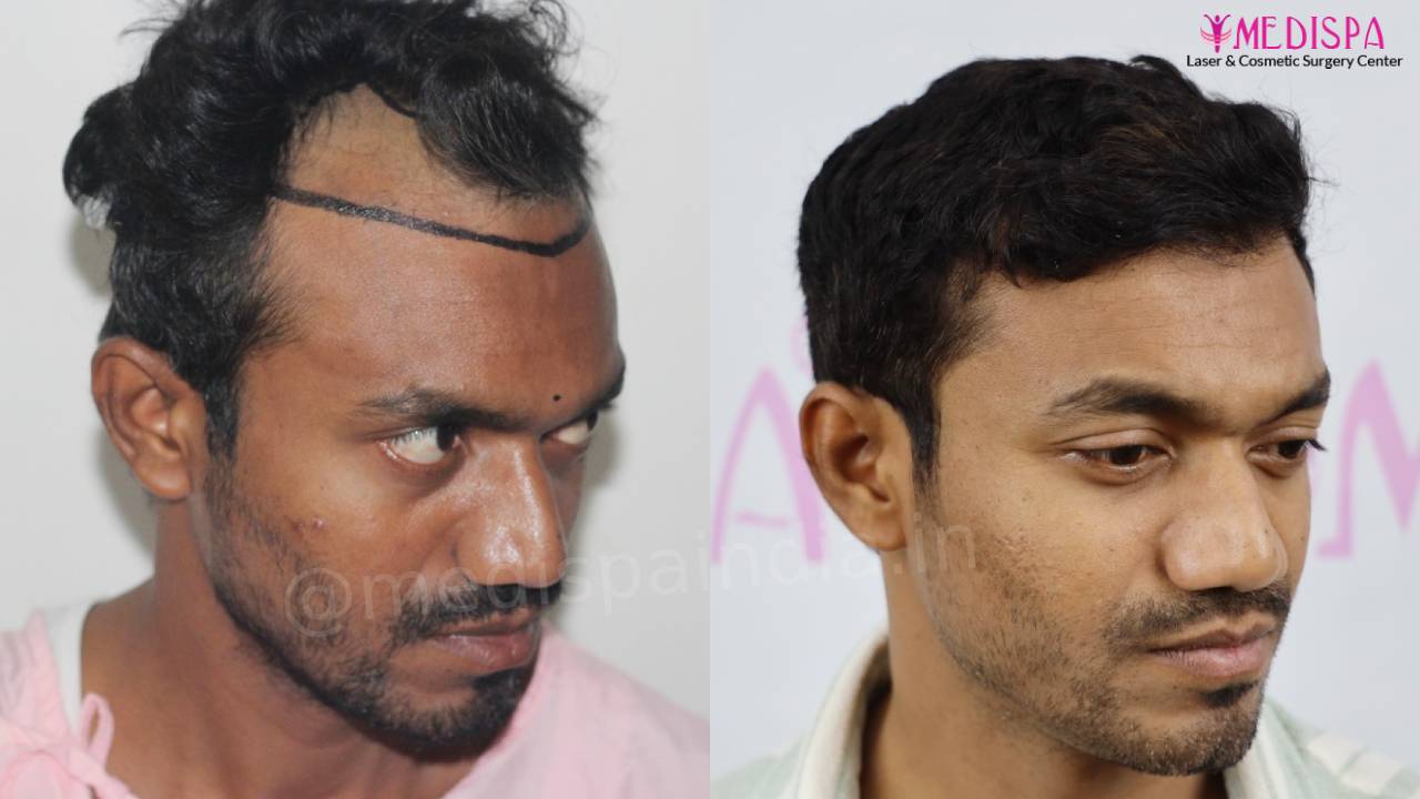 hair transplant result indore