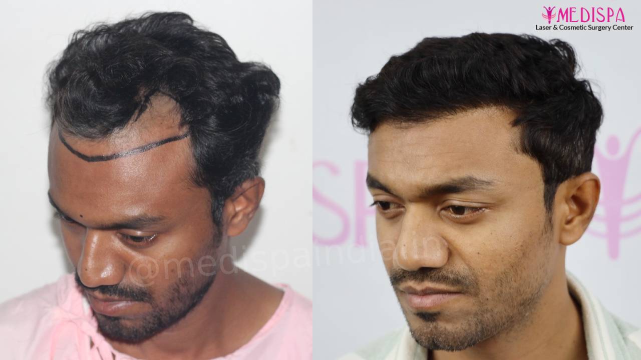 hair transplant result indore