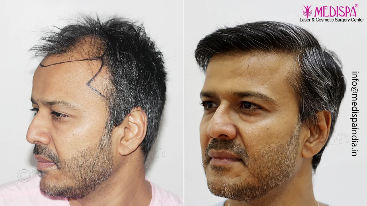 hair transplant surgeon result india