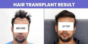 Explain the Methods of Hair Transplant with Their Success Rate