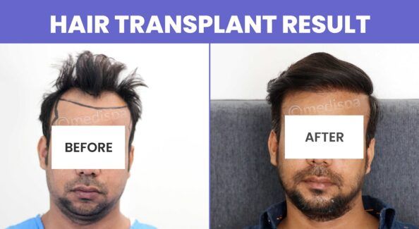 Explain the Methods of Hair Transplant with Their Success Rate