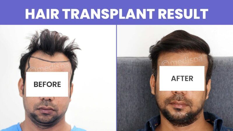 Explain the Methods of Hair Transplant with Their Success Rate