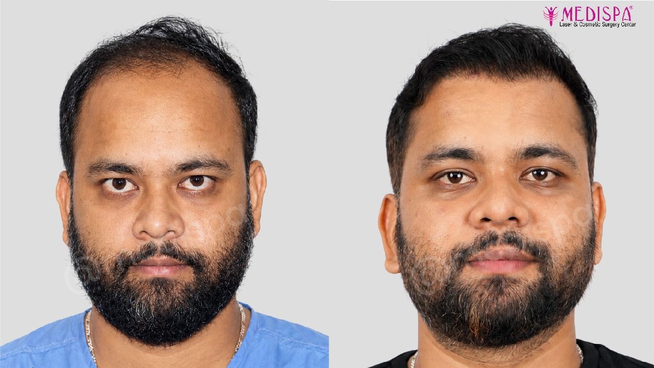 delhi hair transplant cost