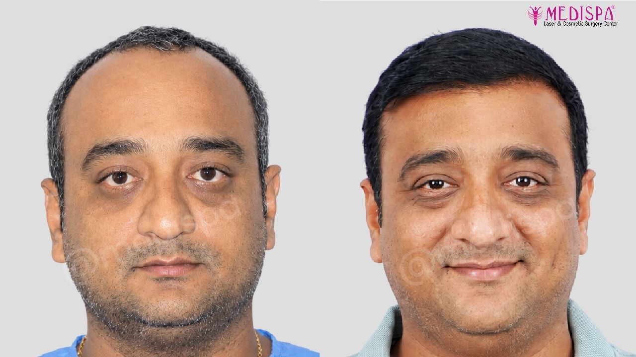 hair transplant cost in India