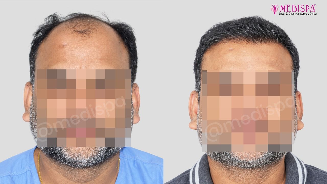 hair transplant cost in India