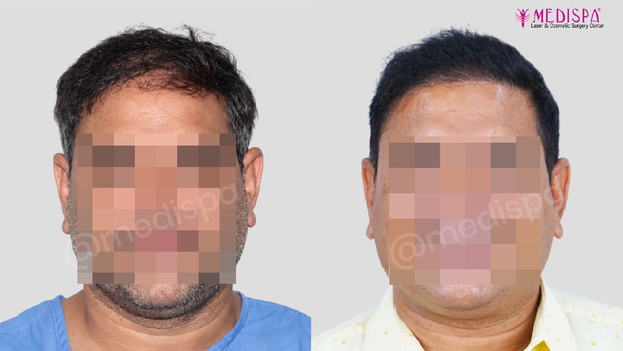 hair transplant cost in india