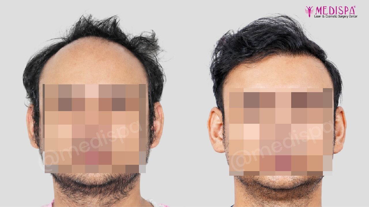 delhi hair transplant cost