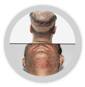 combine hair transplant jaipur india
