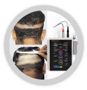 affordable hair transplant cost jaipur