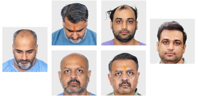  hair transplant India