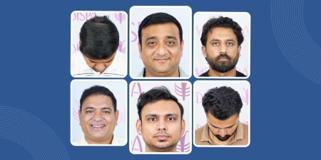hair transplant india