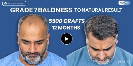 hair transplant cost