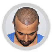 hair transplant in delhi
