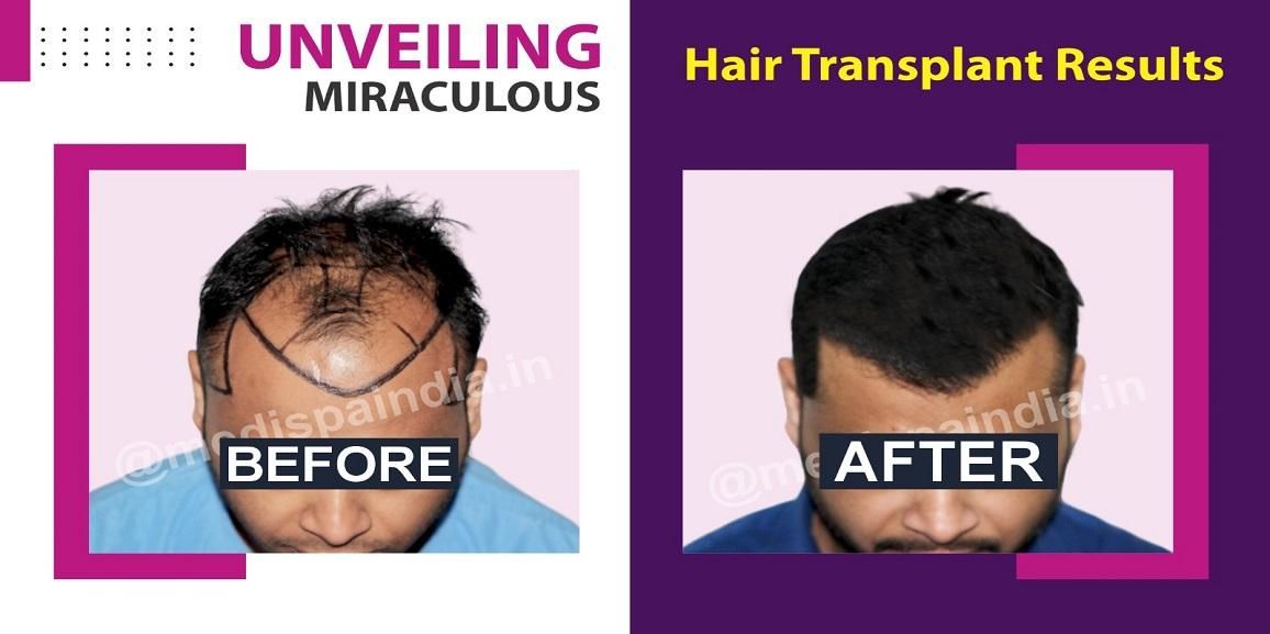 Explain The Precautionary Measures Before And After Hair Transplant