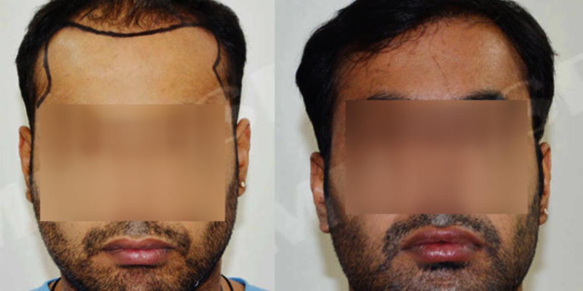 How is FUT+FUE Technique of Hair Transplant Better Than Other Methods?