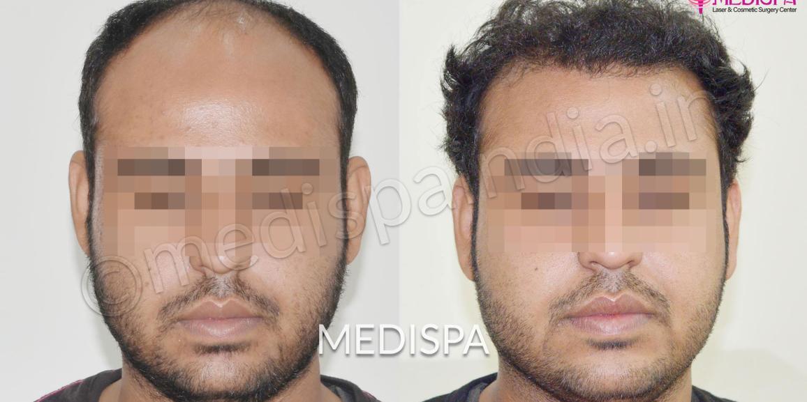 What makes it Popular to receive Hair Transplant in Jaipur rather than Mumbai